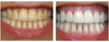 Before & After 之前和之后 | Smilelove 香港